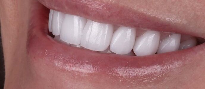 Smile Makeover & Veneers: Cathy - After