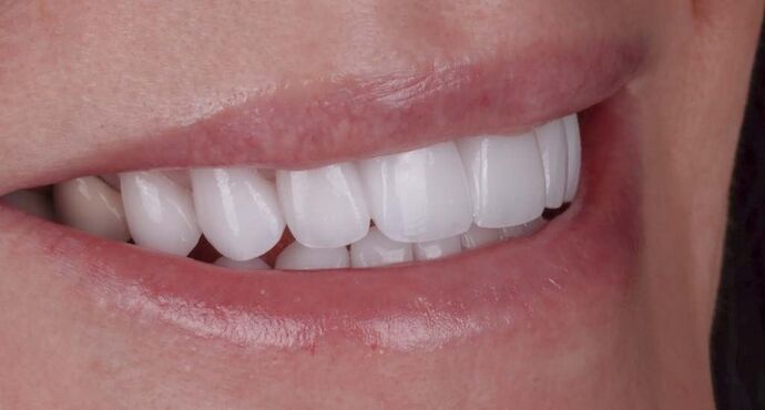 Smile Makeover & Veneers: Cathy - After