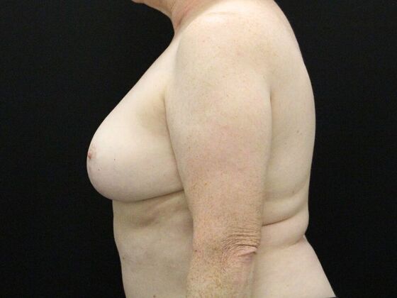 Breast Reduction & Lift: Case 36 - After