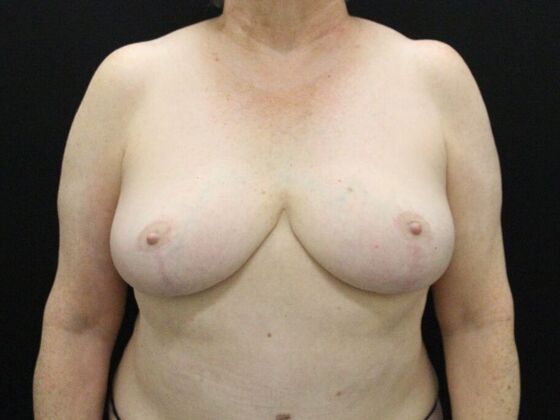 Breast Reduction & Lift Case 36 - After