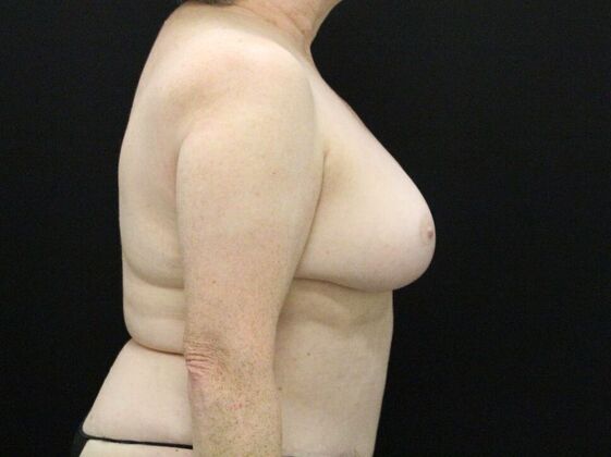 Breast Reduction & Lift: Case 36 - After