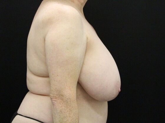 Breast Reduction & Lift: Case 36 - Before