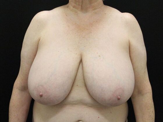 Breast Reduction & Lift Case 36 - Before