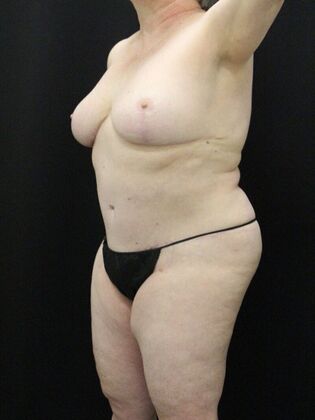 Tummy Tuck: Case 74 - After