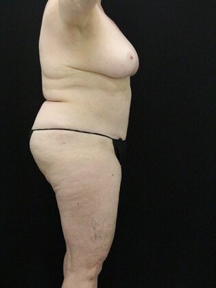 Tummy Tuck: Case 74 - After