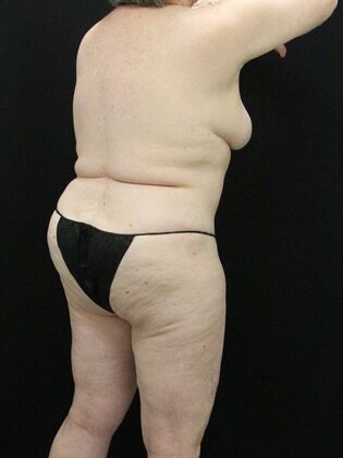 Tummy Tuck: Case 74 - After