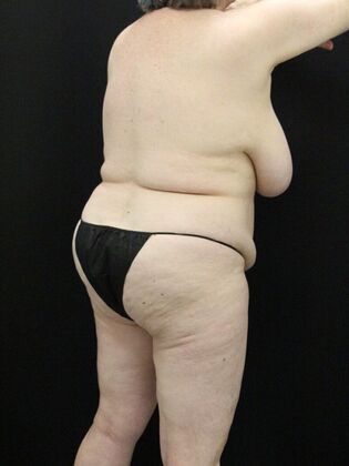 Tummy Tuck: Case 74 - Before