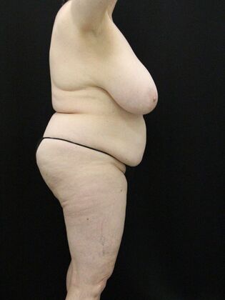 Tummy Tuck: Case 74 - Before