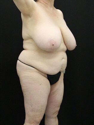 Tummy Tuck: Case 74 - Before