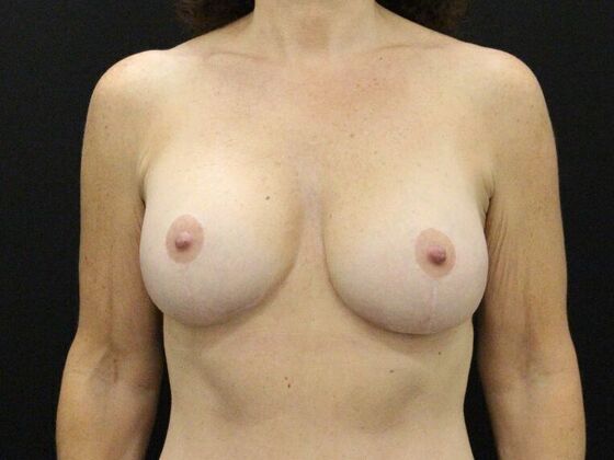 Breast Augmentation Case 55 - After