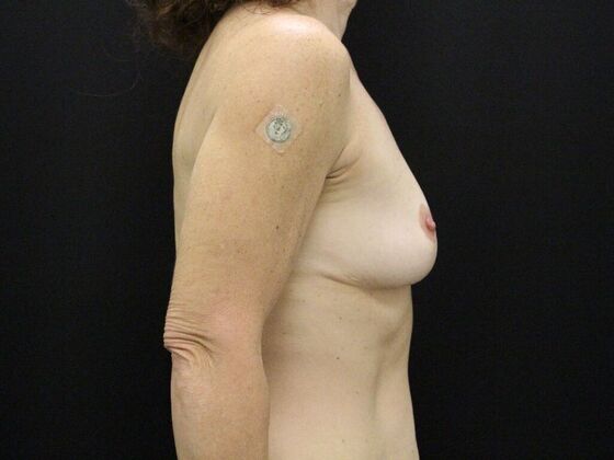 Breast Augmentation: Case 55 - Before