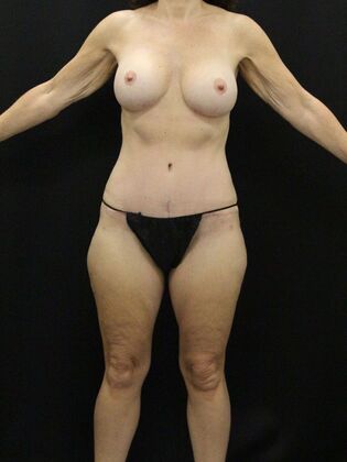 Tummy Tuck Case 75 - After