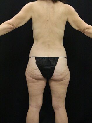 Tummy Tuck: Case 75 - Before