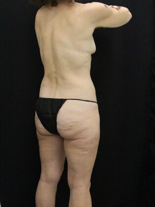 Tummy Tuck: Case 75 - Before