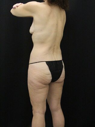 Tummy Tuck: Case 75 - Before