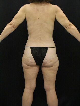 Liposuction Case 62 - After
