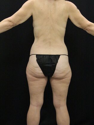 Liposuction Case 62 - Before