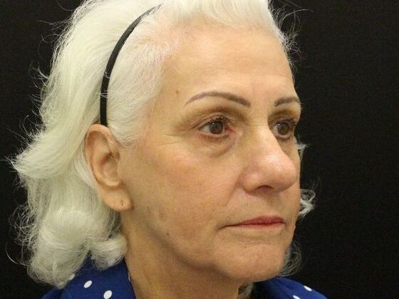 Brow Lift: Case 1 - After