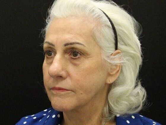 Brow Lift Case 1 - After