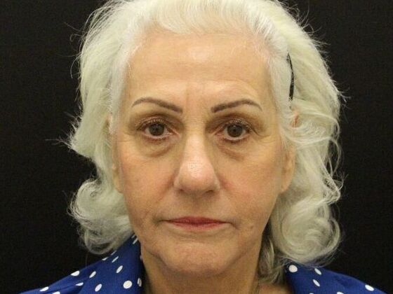 Brow Lift: Case 1 - After