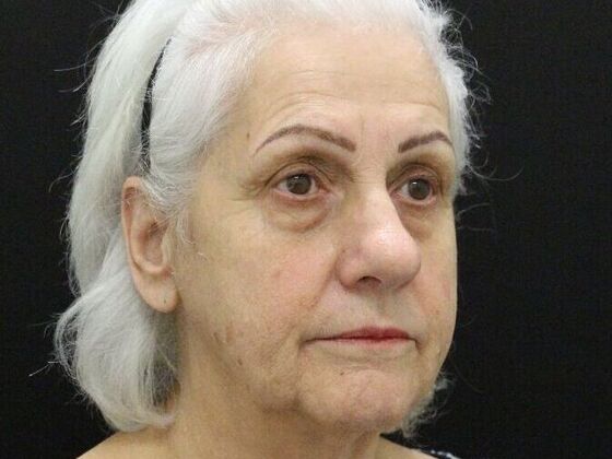 Brow Lift: Case 1 - Before