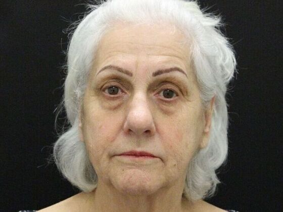 Brow Lift: Case 1 - Before