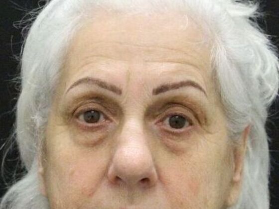 Brow Lift: Case 1 - Before