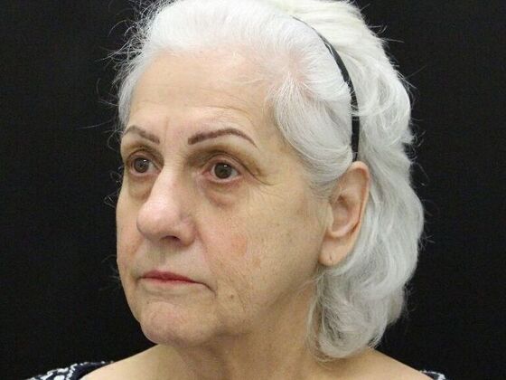 Brow Lift Case 1 - Before