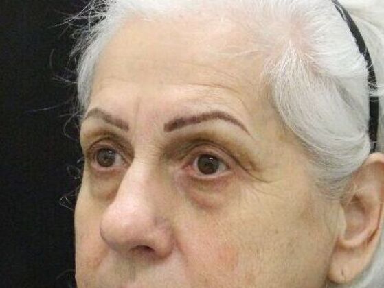 Brow Lift Case 1 - Before