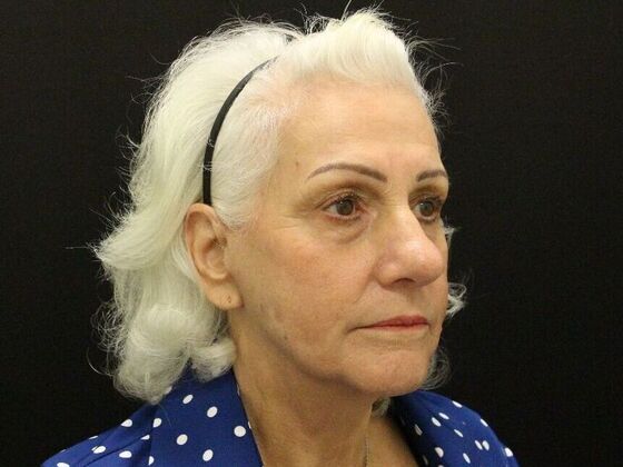 Non-Surgical: Case 1 - After