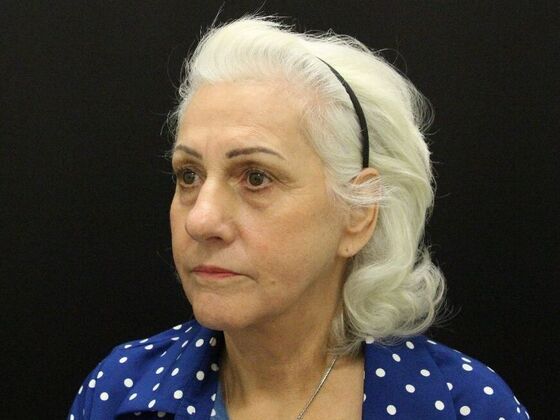 Non-Surgical: Case 1 - After