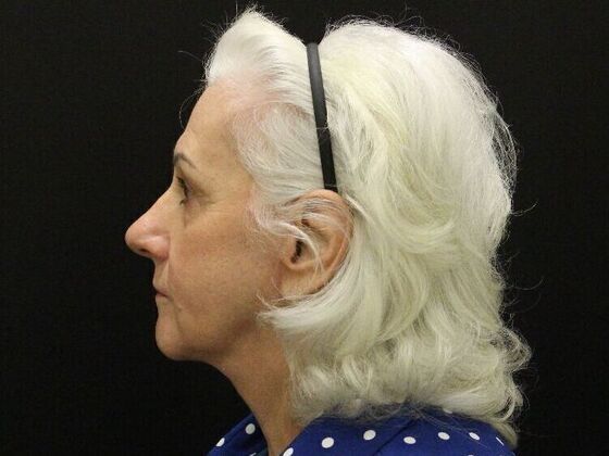 Non-Surgical: Case 1 - After