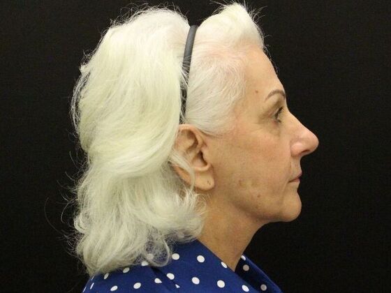 Non-Surgical: Case 1 - After