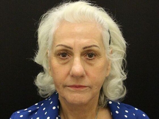 Non-Surgical Case 1 - After