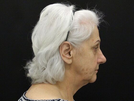 Non-Surgical: Case 1 - Before