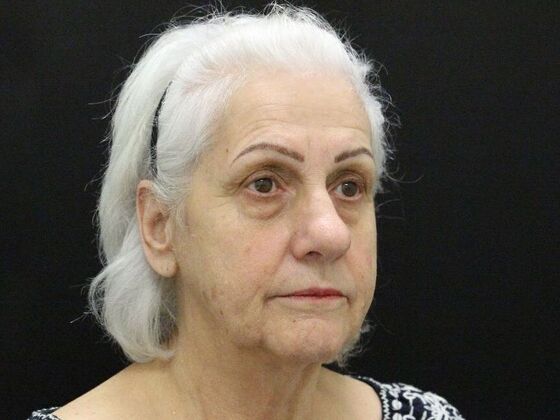 Non-Surgical: Case 1 - Before