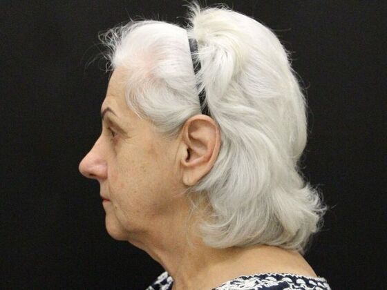 Non-Surgical: Case 1 - Before