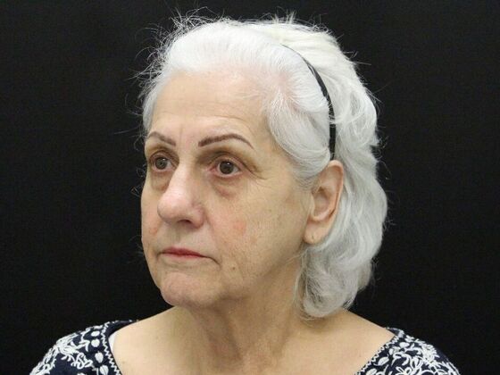 Non-Surgical: Case 1 - Before