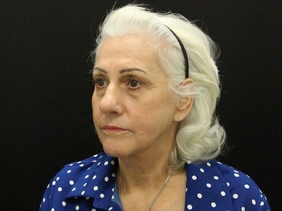 Face & Neck Lifts: Case 5 - After