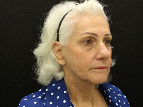 Face & Neck Lifts: Case 5 - After