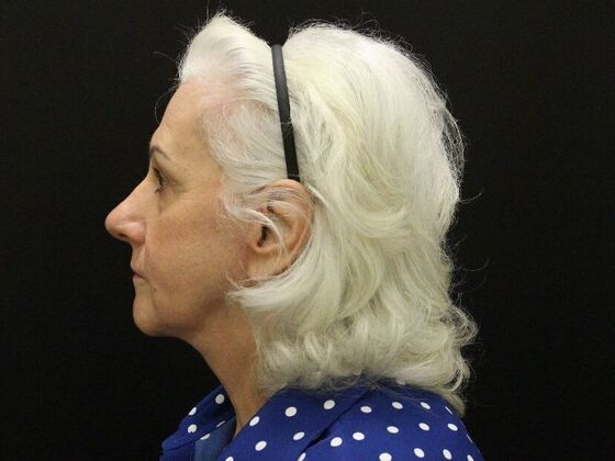 Face & Neck Lifts: Case 5 - After