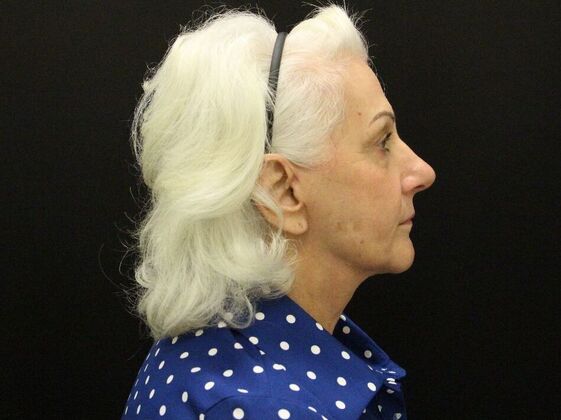 Face & Neck Lifts Case 5 - After