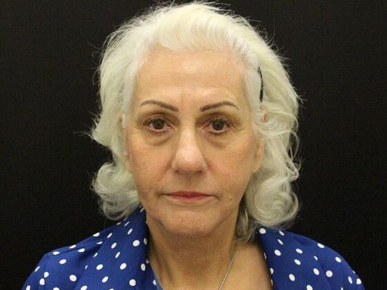 Face & Neck Lifts: Case 5 - After