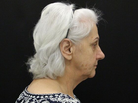 Face & Neck Lifts Case 5 - Before