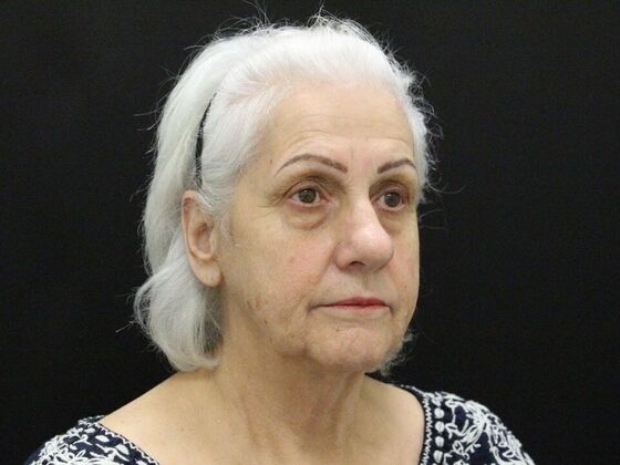 Face & Neck Lifts: Case 5 - Before