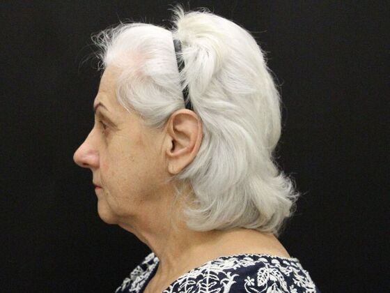 Face & Neck Lifts: Case 5 - Before