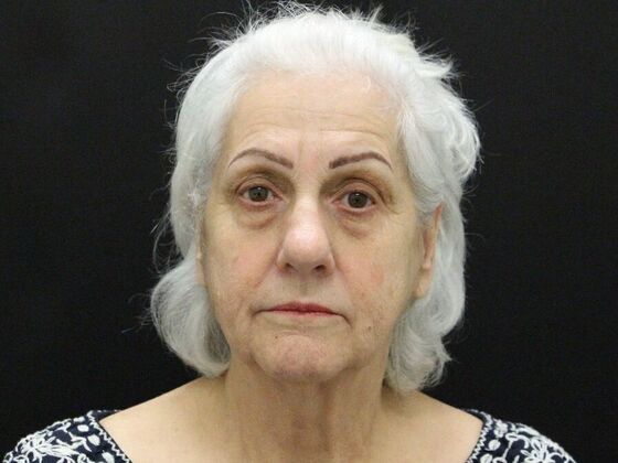 Face & Neck Lifts: Case 5 - Before