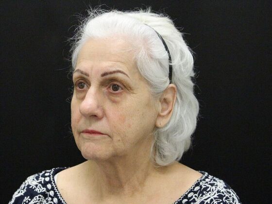 Face & Neck Lifts: Case 5 - Before