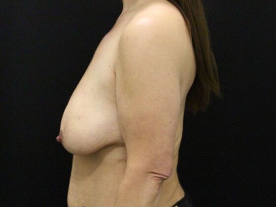 Breast Lift & Breast Lift Augmentation: Case 60 - Before
