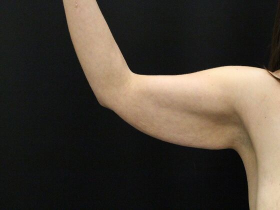 Arm Lift & Reduction: Case 14 - Before